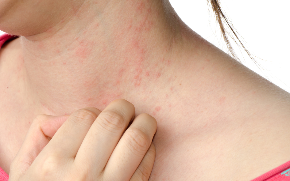 Darstellung Allergie
